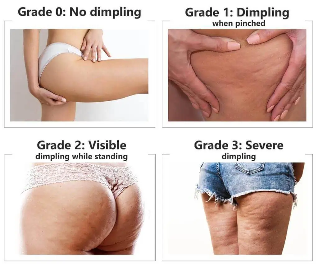 Representation of the stages of cellulite development Avon